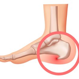 Почему болит пятка? Всё о пяточной шпоре и способах её устранения