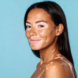 Ашық түсті дақтар: Витилиго дегеніміз не және қалай сенімділікті қайтаруға болады