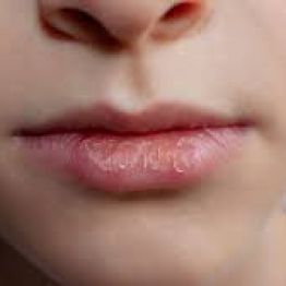 Құрғақ, жарылған еріндер: себептері, белгілері және емдеу тәсілдері