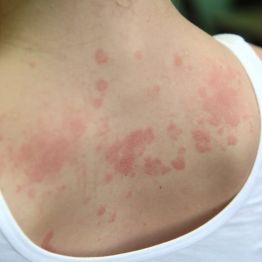 Хроническая крапивница: болезнь, которую сложно объяснить, но можно лечить