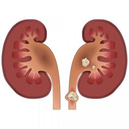 Бүйректегі тас туралы не білу керек