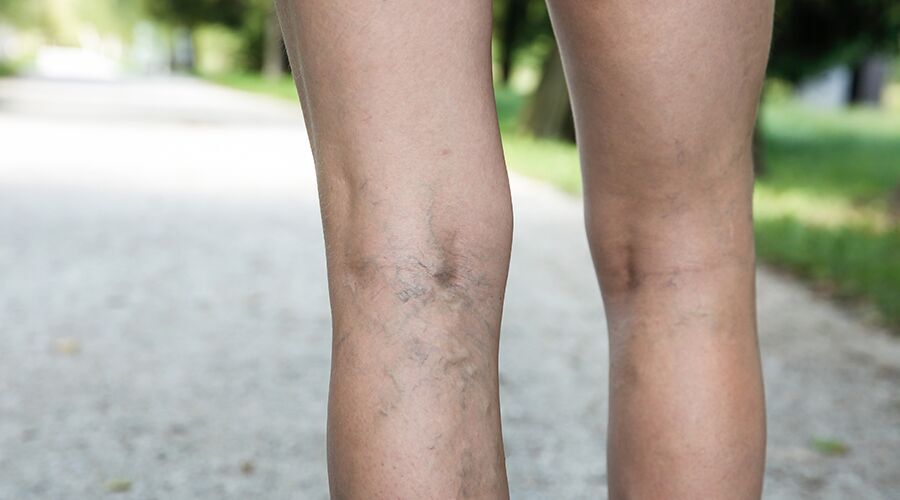 varicose veins.jpeg