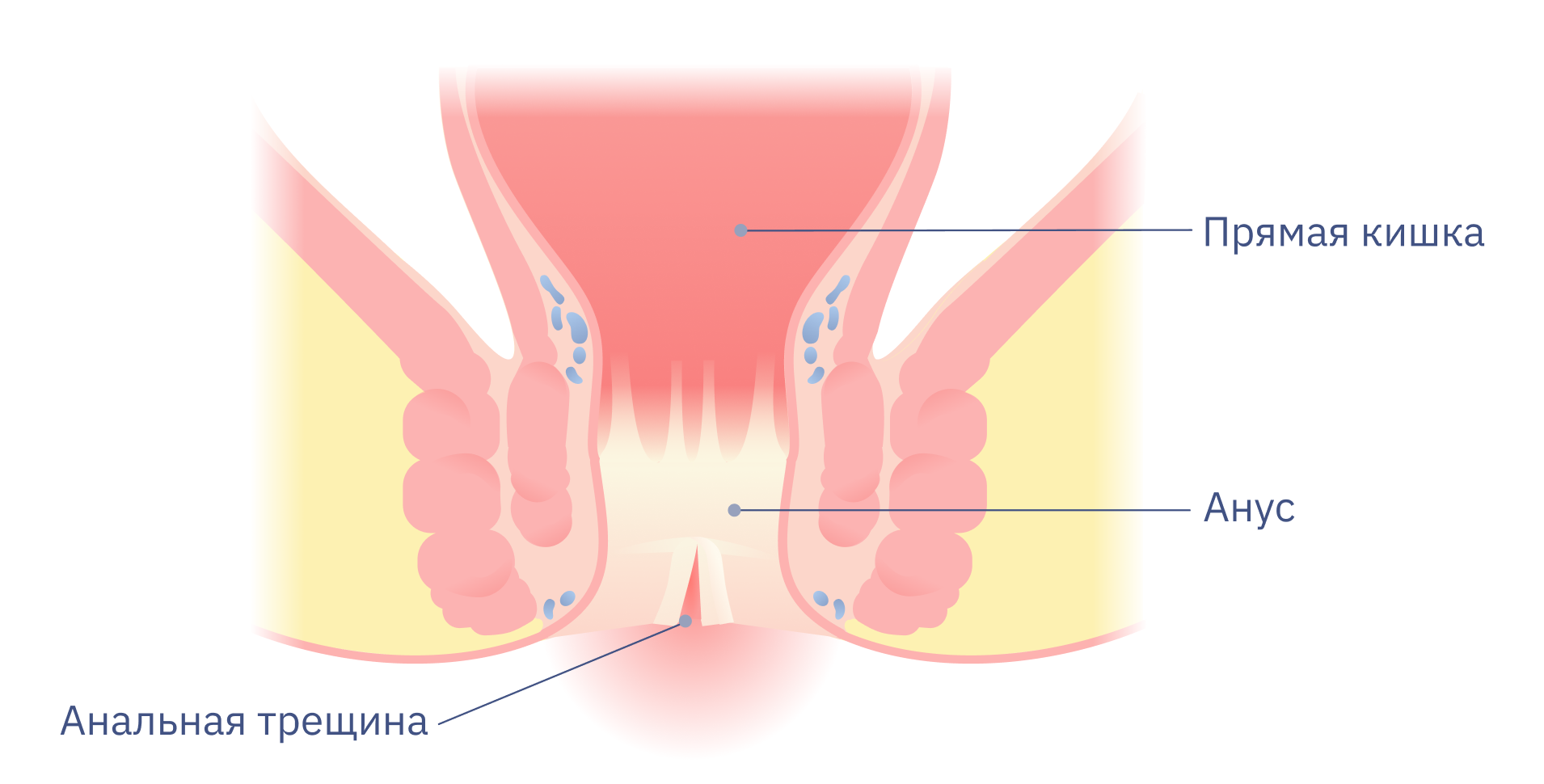 анальная трещина_1.png